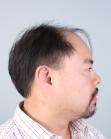 Before Hair Transplant&nbsp;Front